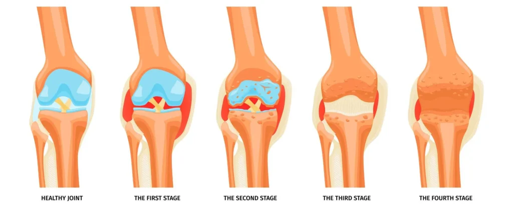 Joint pain treatment in Delhi
