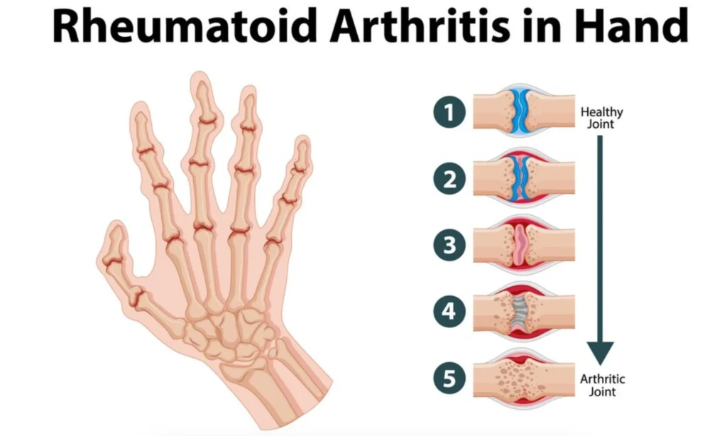 Rheumatoid arthritis treatment in Delhi
