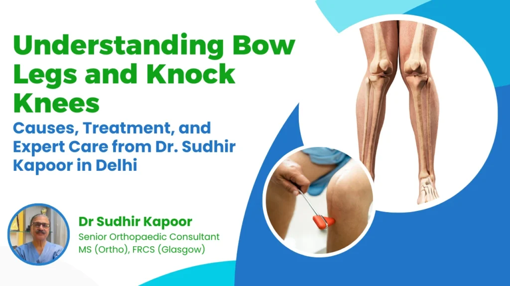 knock knees treatment Delhi